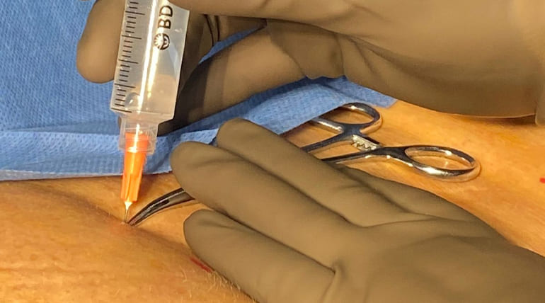 Infiltraciones musculares